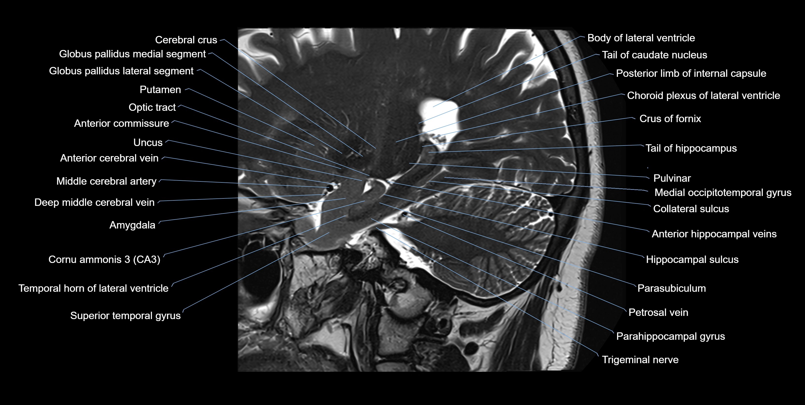 hippocampus sagittal cross sectional anatomy 3T MRI images -img-10008.webp